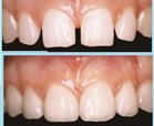 veneers