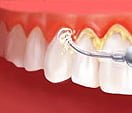 gum_treatment