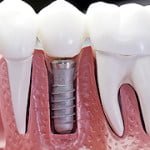 implants